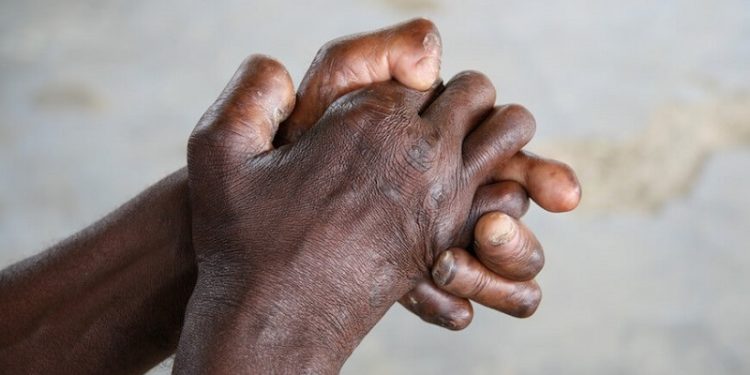 बालबालिकामा कुष्ठरोग सङ्क्रमण बढ्दै गएर स्वास्थ्य चुनौती थप